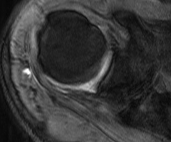 Infraspinatous Tendinosis